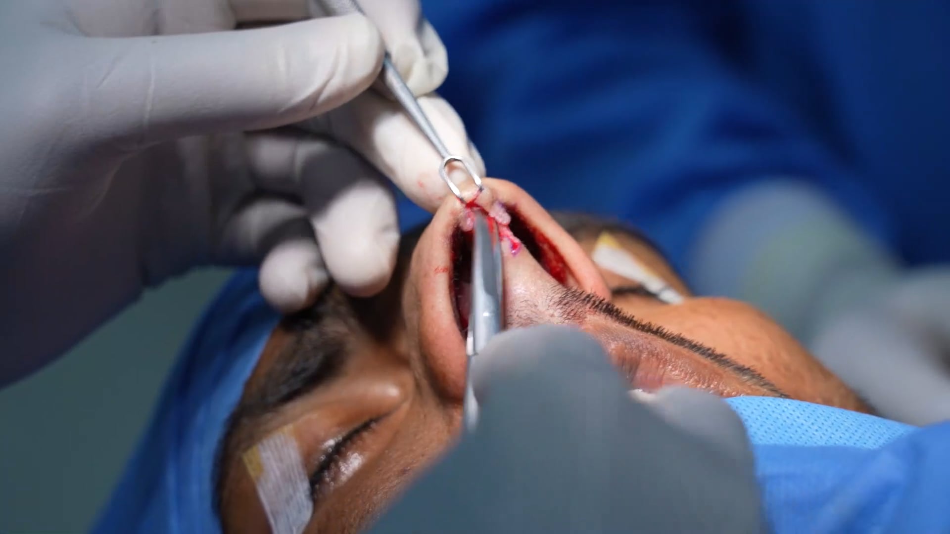 Rhinoplasty Surgery